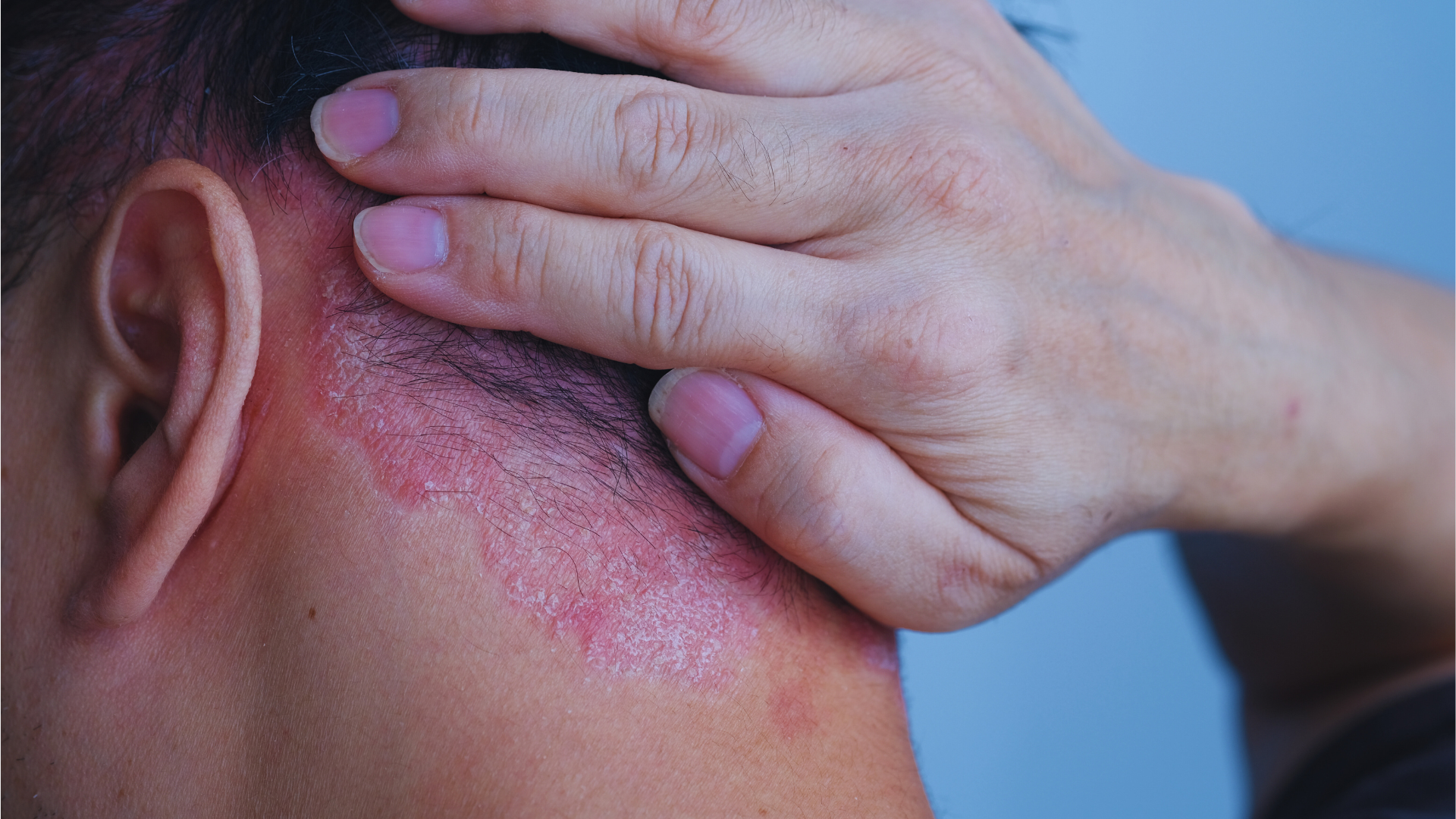 Psoriasis Awareness Month: A Professional's Guide to Assessment and Support